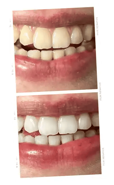 ONLYSMILE polvo blanqueador dental