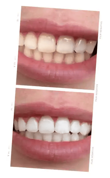 ONLYSMILE gel blanqueador dental