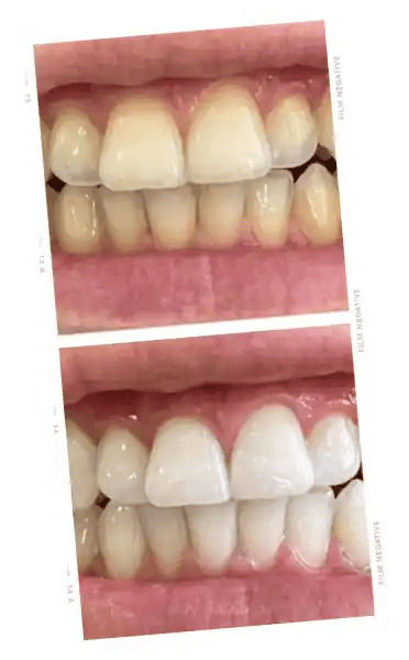 ONLYSMILE polvo blanqueador dental